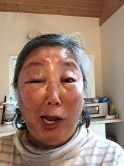 Alaskan botox